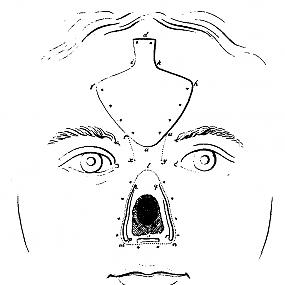 forehead-flap-rhinoplasty