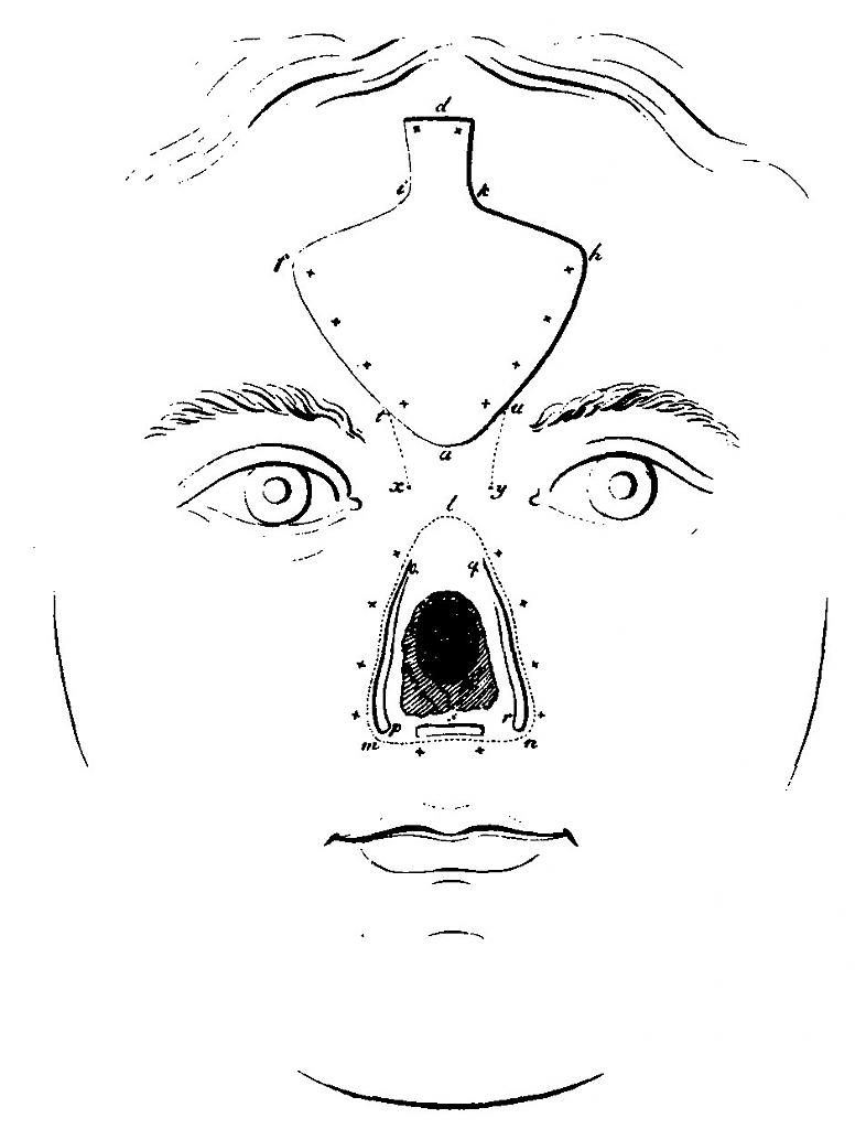 forehead-flap-rhinoplasty