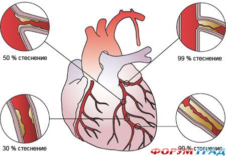 стенокардия