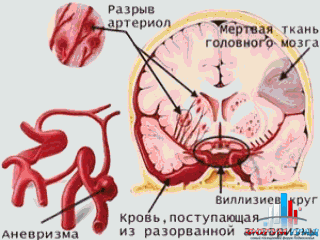 инсульт