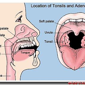 удаление миндалин